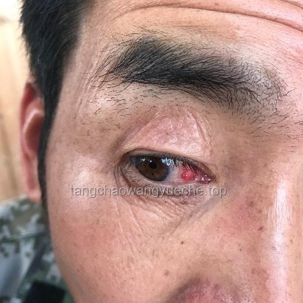**右眼狂飙泪？警惕！这可能是泪囊里长了瘤子的信号**